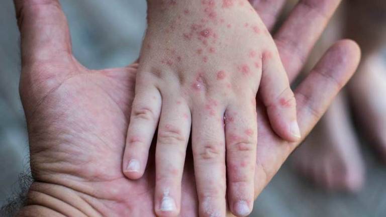 Viruela del mono, qué es y cuáles son sus síntomas